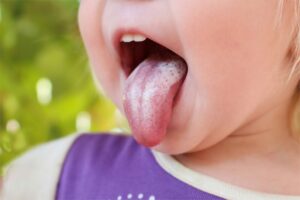 Child's tongue with oral thrush