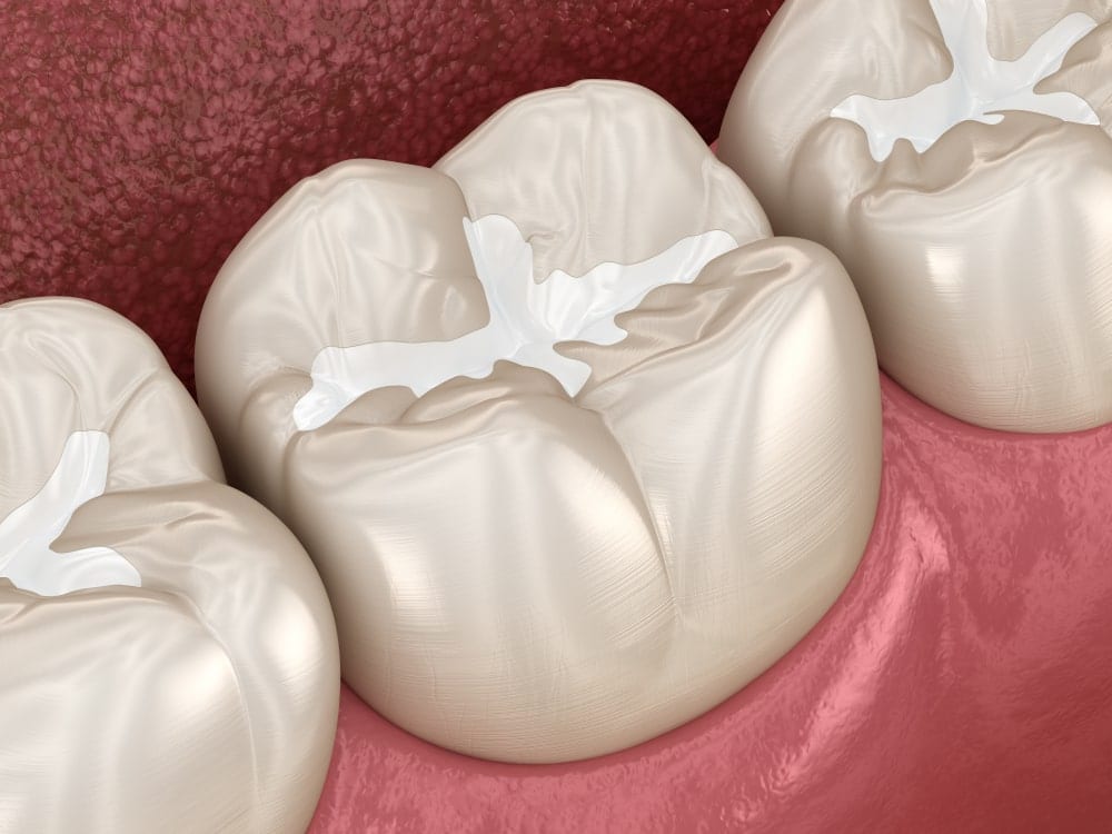 Dental Cavities in Molars