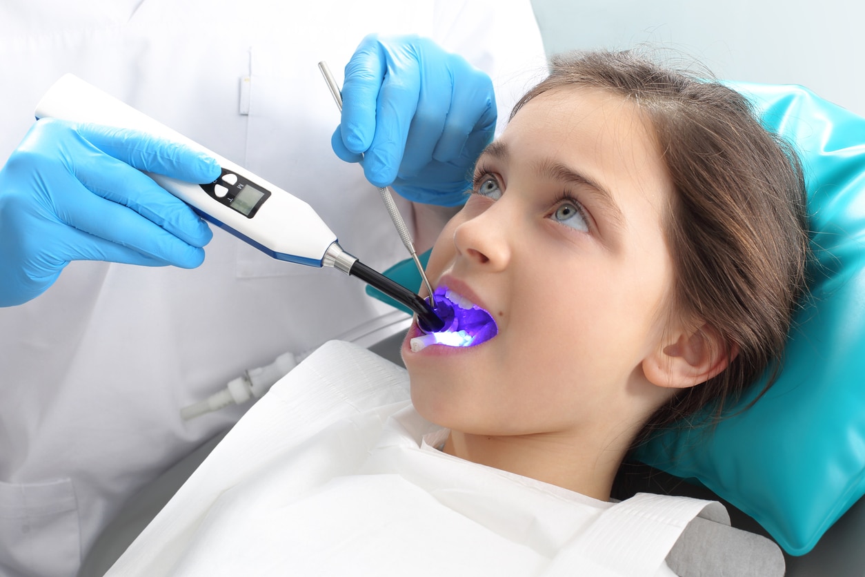 Young girl in dentist chair with uv light in her mouth while dentist applies sealant. Blue gloved dentist holds dental tools in her mouth