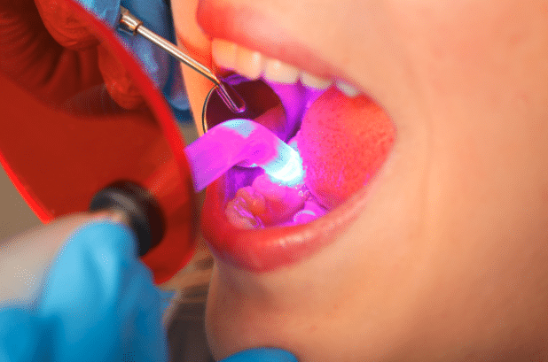 Close up of dentist using lighted tool to in bonding procedure